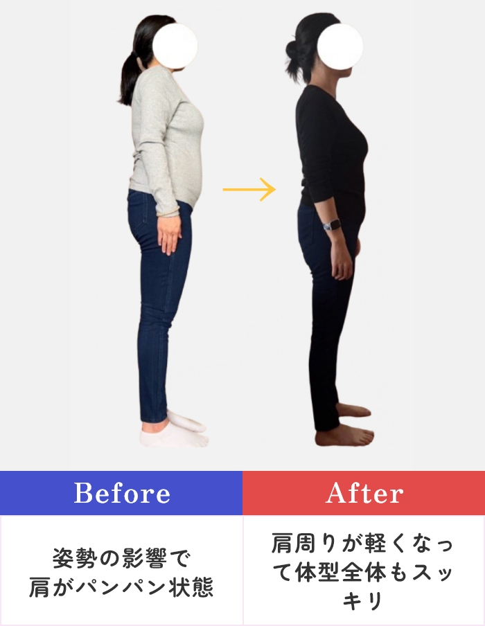 【Before】姿勢の影響で肩がパンパン状態 → 【After】肩周りが軽くなって体型全体もスッキリ