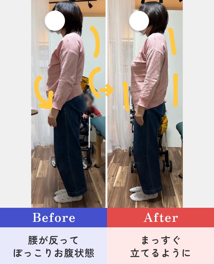 【Before】腰が反ってぽっこりお腹状態 → 【After】まっすぐ立てるように
