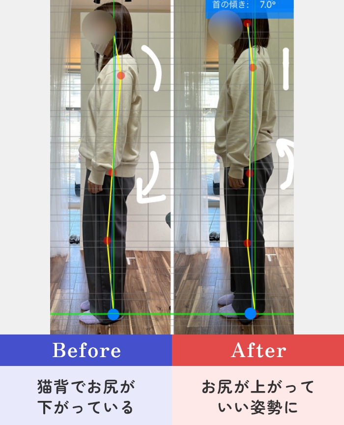 【Before】猫背でお尻が下がっている → 【After】お尻が上がっていい姿勢に